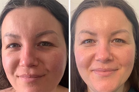 Vorher Nachher: Manuelles Lifting